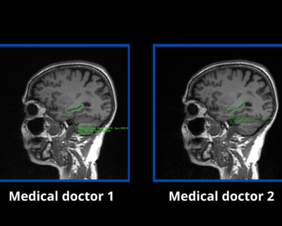 Morphological measurements of the hippocampus using artificial intelligence: a first database in Ecuador
