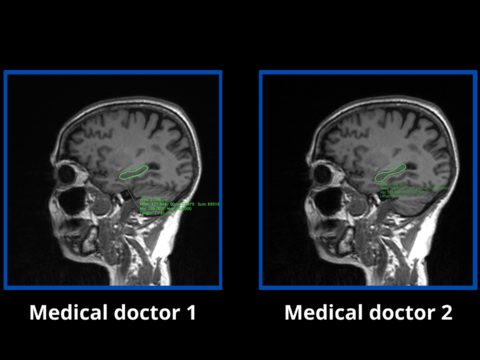 Morphological measurements of the hippocampus using artificial intelligence: a first database in Ecuador