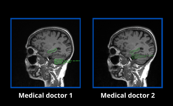 Morphological measurements of the hippocampus using artificial intelligence: a first database in Ecuador