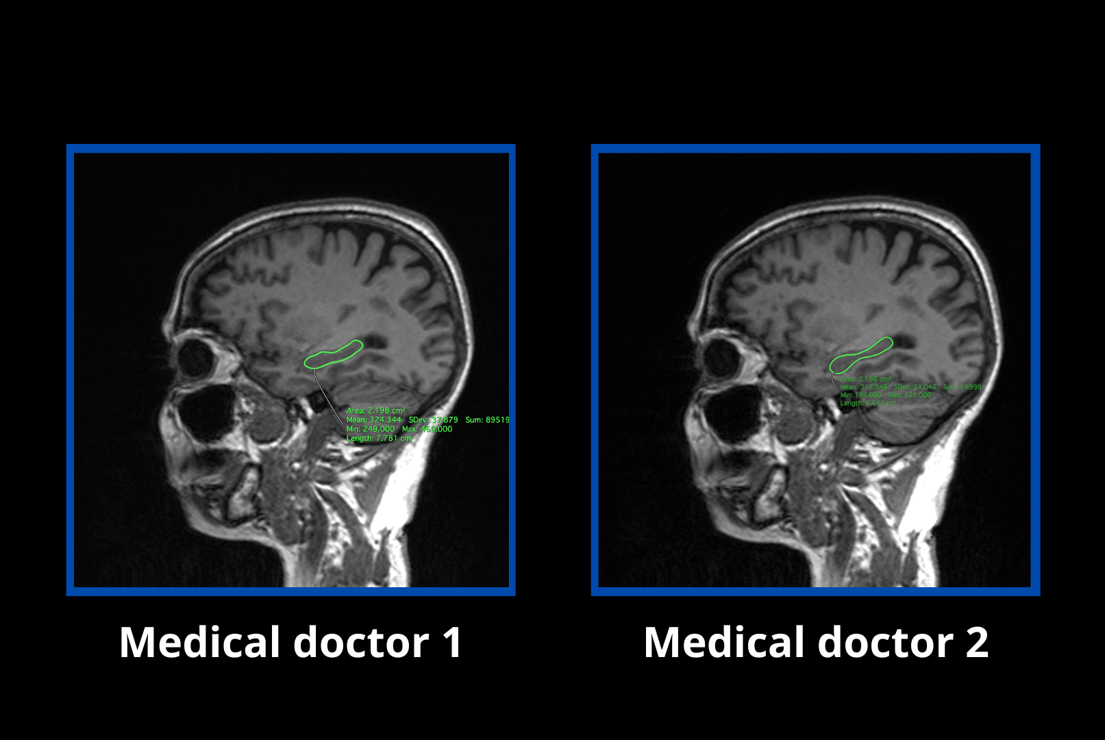 Morphological measurements of the hippocampus using artificial intelligence: a first database in Ecuador